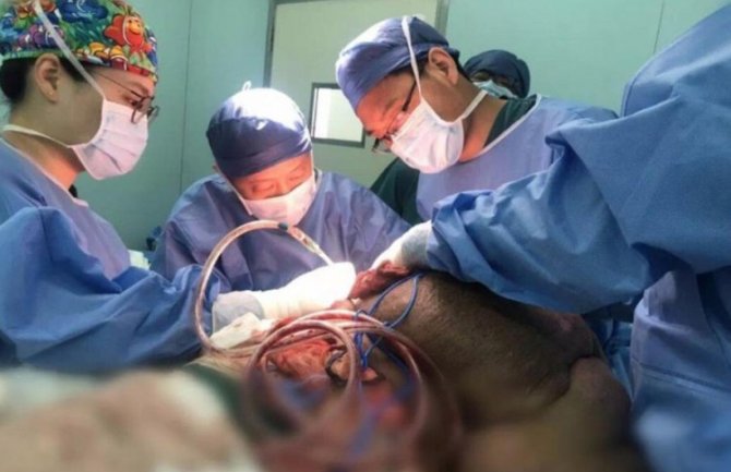 Tim od više od 100 hirurga 33 sata uklanjao tumor