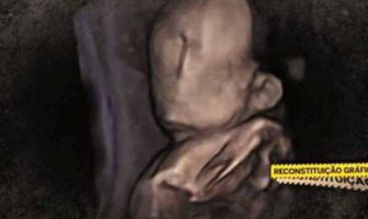 Rođena beba bez lica, ginekolog pod istragom
