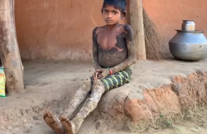 Indija: Djevojčica boluje od rijetke bolesti koja je pretvara u kamen (VIDEO)