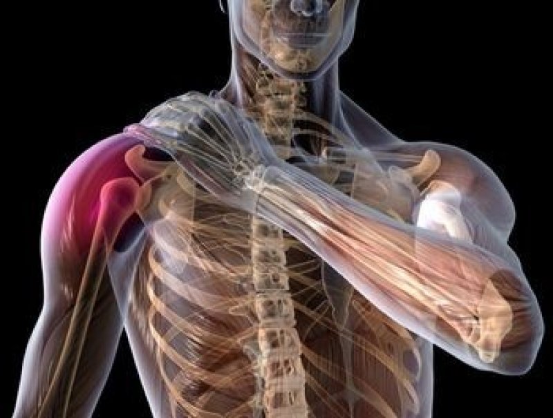 bol u ramenu u onkologiji naziv liječenja boli u ramenu