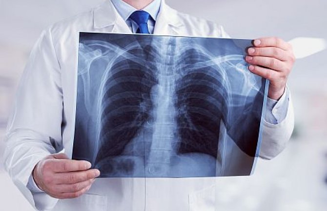Pluća oštećena virusom mogu da se oporave za tri mjeseca