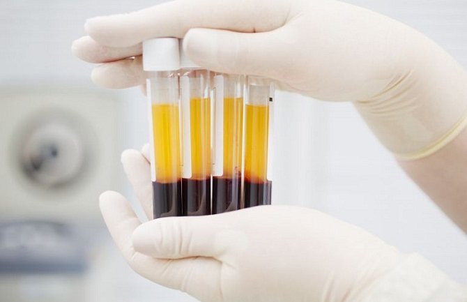 Počinje najveće probno testiranje krvi u svijetu na 50 tipova karcinoma