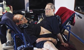 Preminuli sijamski blizanci s najdužim životnim vijekom