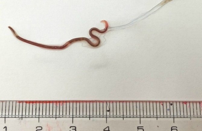 Gadno iznenađenje: Jela sirovo meso i u grlu joj pronašli crva od četiri centimetra