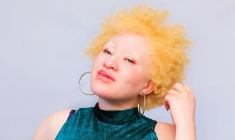 „Moj silovatelj je vjerovao da će ga napad na albino osobu zaštititi od bolesti